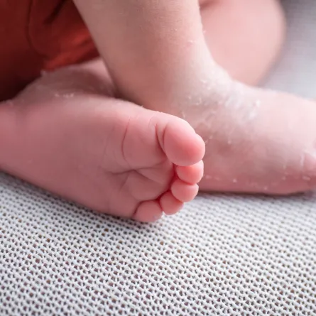 صورة لقدم طفل يعاني من تقشير الجلد