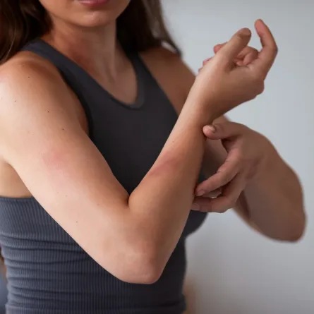 الوقاية من الجدري القرود تحميك من المرض