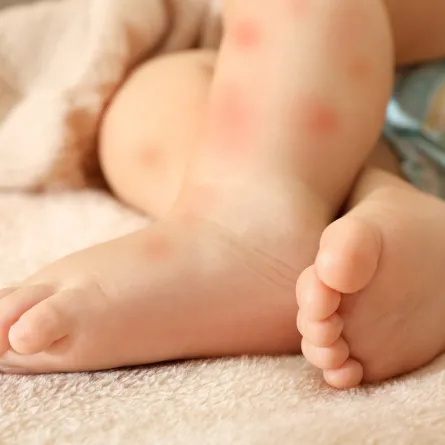 صورة لطفل مصاب بالطفح الجلدي