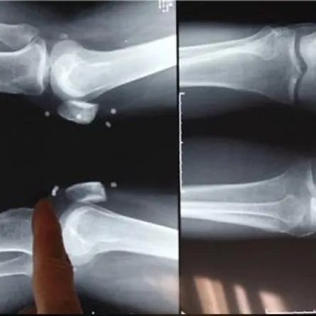 استخراج 42 لؤلؤة من جسد صيني