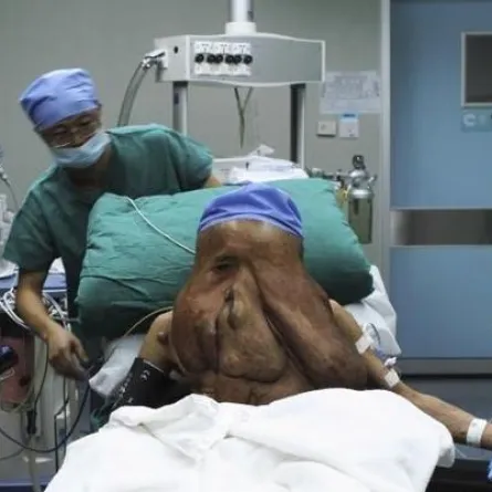 الرجل الفيل يخضع لـ 3 عمليات جراحية جديدة