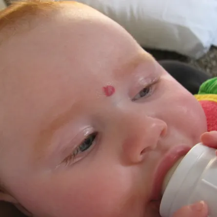 وحمات في طفلي