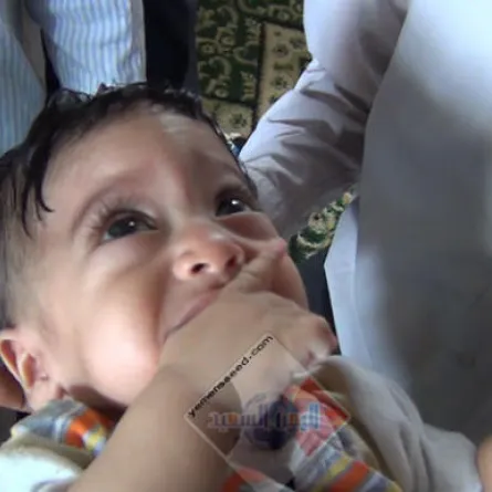 طفل يحمل جنيناً في أحشائه