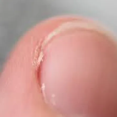 أسباب تكون الجلد الزائد حول الأظافر..