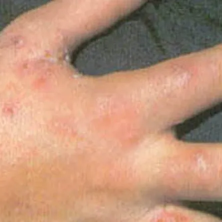 انخفاض الوعي بسرطان الجلد بين الأقليات