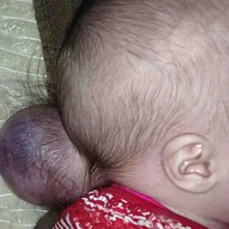 طفلة تولد بكتلة لحمية خارج رأسها تحوي جزءاً من دماغها!