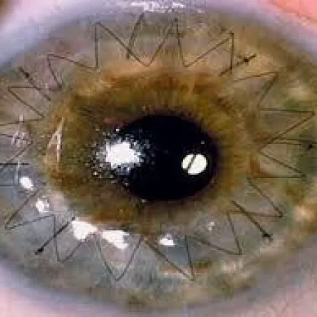 أول حالة تبرع بالأعضاء بعد الموت في فلسطين