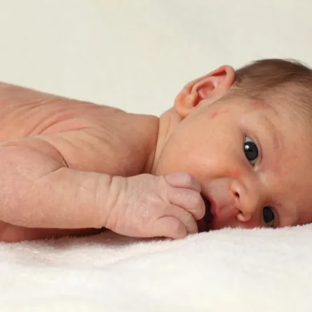 احمي طفلك من مرض الأكزيما!