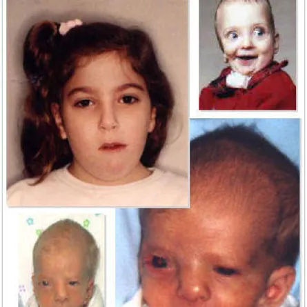 فريق بحث سعودي يحدد مورثة جديدة لمتلازمة الوجة والفم والأصابع