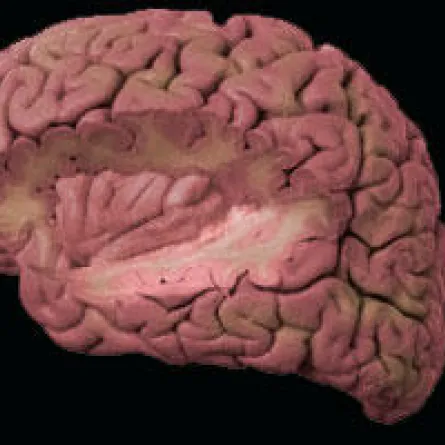 اضطرابات النوم تصيب بالاكتئاب والسكري والسمنة وأمراض القلب