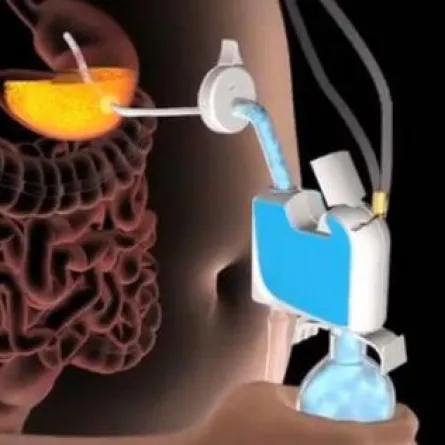 جهاز لشفط الدهون من الجسم خلال 20 دقيقة