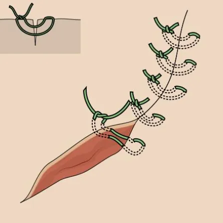 ثورة علمية لخياطة الجروح بالصمغ