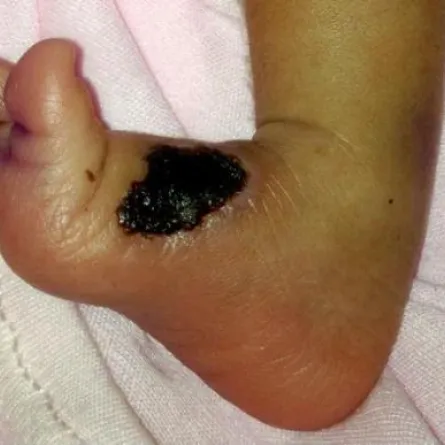 إهمال طبي يتسبب بحرق قدم رضيعة في الخرج