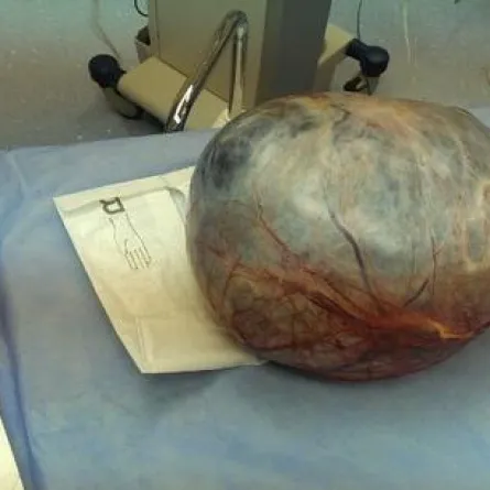 استخراج كيس ورمي لمريضة بمستشفى في مكة