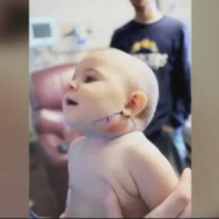 استخراج "ريشة" من وجه رضيعة