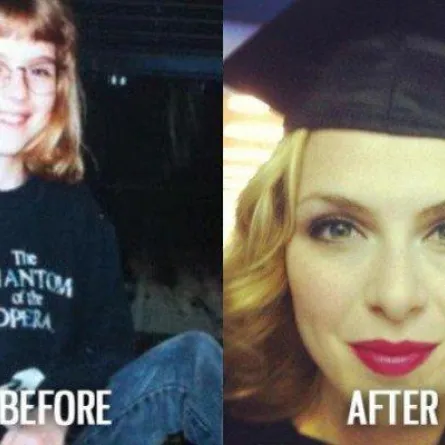 متلازمة البطة القبيحة مرض يتمناه الجميع