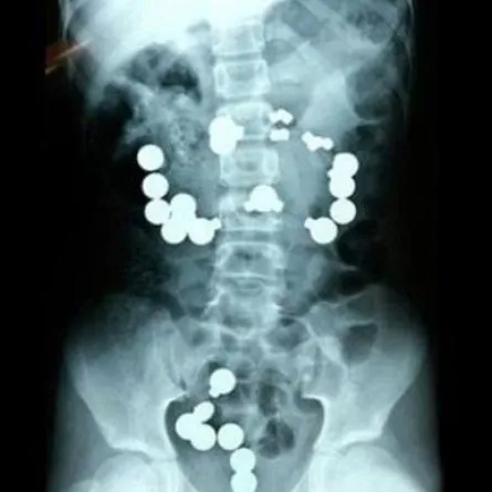 طفل يبتلع 42 قطعة معدنية للديكور