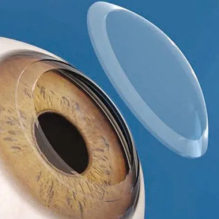 مدينة سعود الطبية تنجح في زراعة عدسة داخل العين