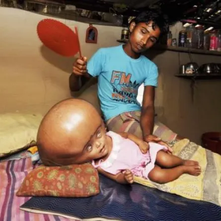 مرض نادر يضاعف حجم رأس طفلة