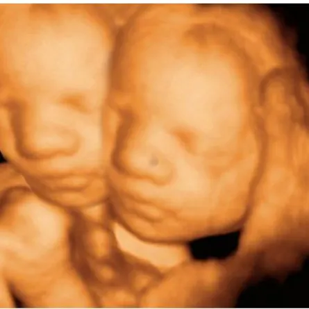 تحمل جنينًا برأسين وترفض إجهاضه