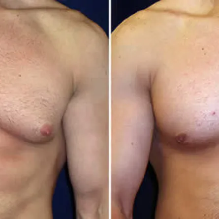 السعوديون يقبلون على عمليات تصغير الثدي