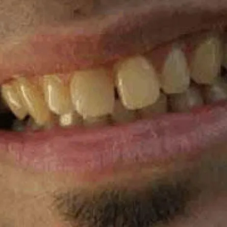 الجزّ على الأسنان يؤدي إلى تلفها وتآكلها