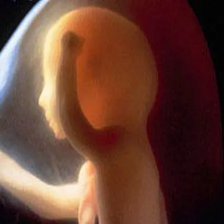 ارتفاع الكلور في خلايا الجنين العصبيَّة دليل على "التوحد"