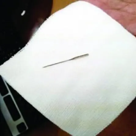 استخراج إبرة خياطة من معدة سعودي