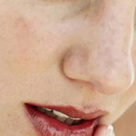 المدخنون أكثر عُرضة للإصابة بسرطان الجلد