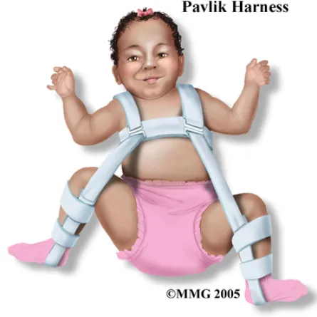 ماذا تعرفين عن خلع الولادة؟