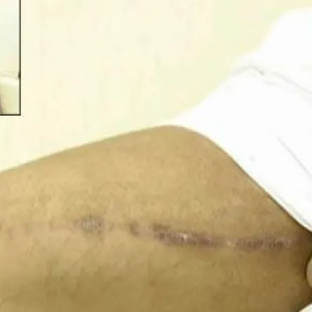 مأساة إماراتي حقن نفسه بالسيلكون