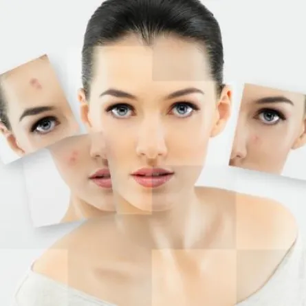 3 خطوات للتخلّص من ندوب حب الشباب