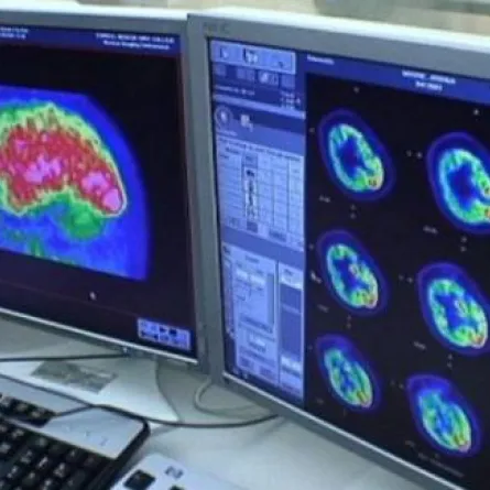 الدهون تكافح سرطان الدماغ