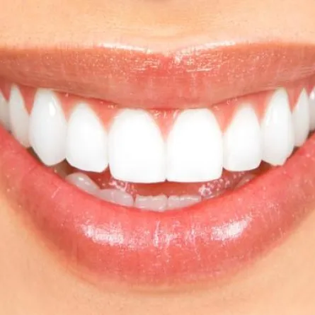 تبييض الأسنان والإبتسامة الكاذبة