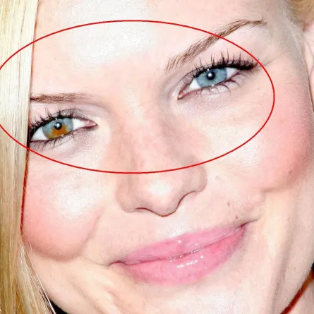 بالصور: مشاهير هوليوود بعيوب خلقية