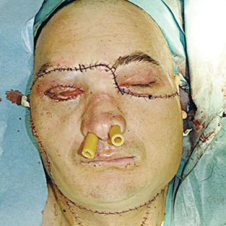 27  ساعة لزراعة وجه بالكامل