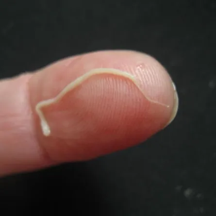 ابتلعت دودة "شريطية" لإنقاص وزنها