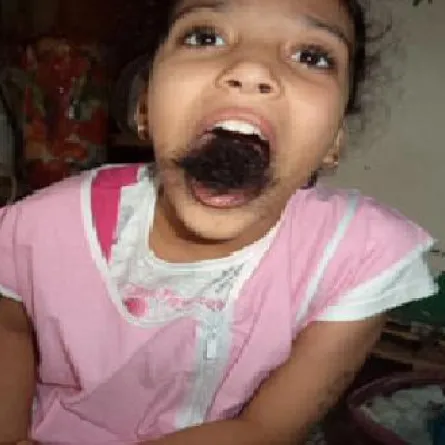 طفلة جزائرية ينمو الشعر في فمها