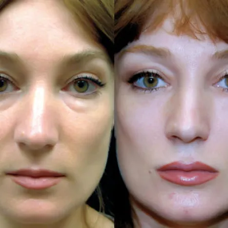 شدّ الوجه ينمّي عظاماً في العينين