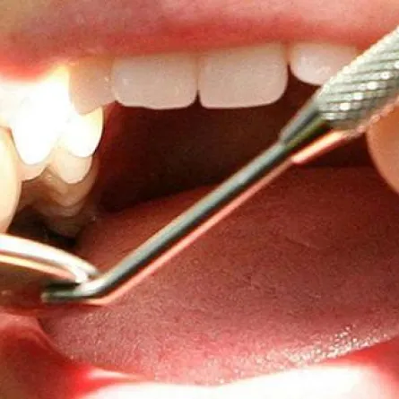 قلة نظافة الأسنان قد يؤدي إلى الزهايمر