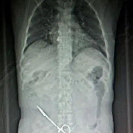 استأصلوا الورم وتركوا المقص بين أحشائه