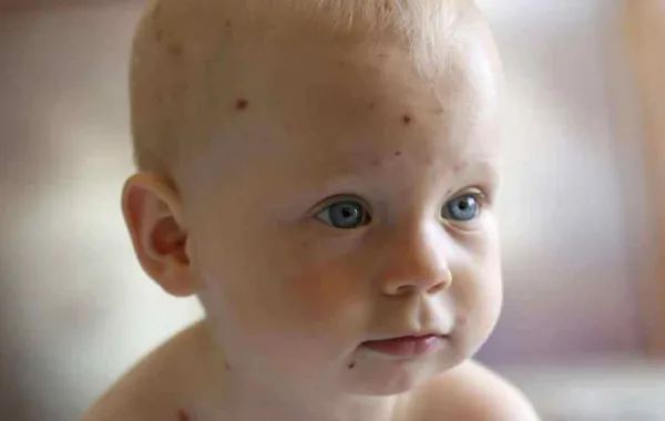 كيف تعالجين الحبوب الحمراء لطفلك بالمنزل؟