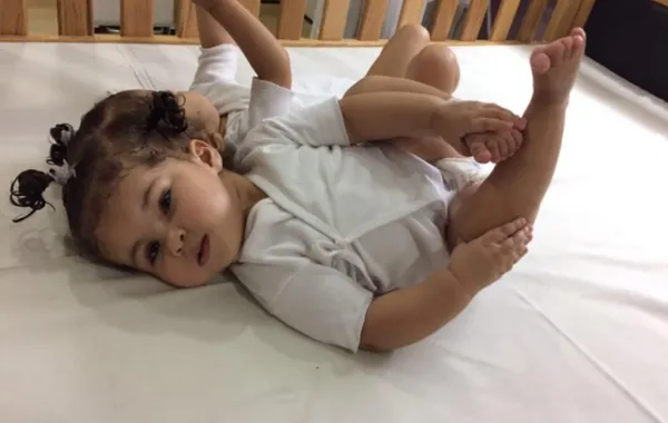 فشل فصل التوأم المصري "مي ومنة" في السعودية