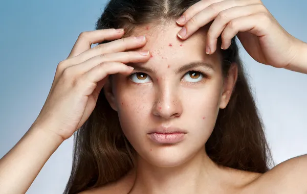 دواء حب الشباب لعلاج التصلب اللويحي المتعدد!