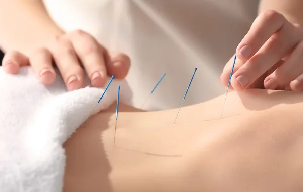 الوخز بالإبر لـ خسارة الوزن بسرعة فائقة!