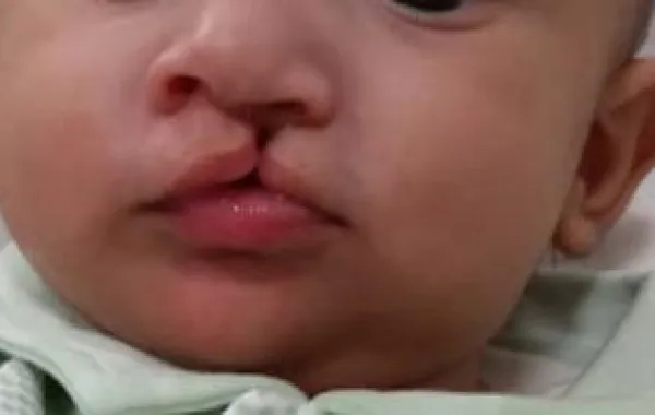 مستشفى الجامعة بالشارقة يداوي طفلة وُلِدَت بشفة مشقوقة