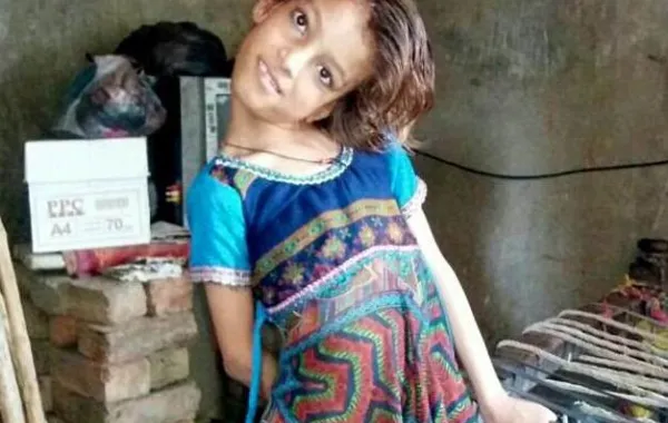 مرض نادر لطفلة رقبتها تلتف حول جسدها