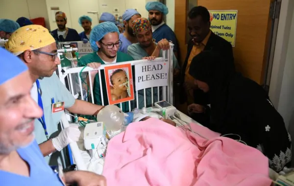 عملية فصل التوأم السوداني جود وجنى تتكلَّل بالنجاح