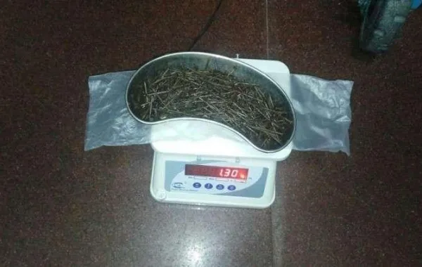 بالفيديو… استخراج 639 مسماراً من أمعاء مريض
