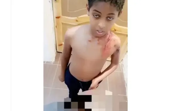 طفلان يسكبان ماءً حاراً على جسد صديقهما في العلا!